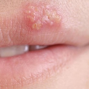 Foods beneficial for herpes