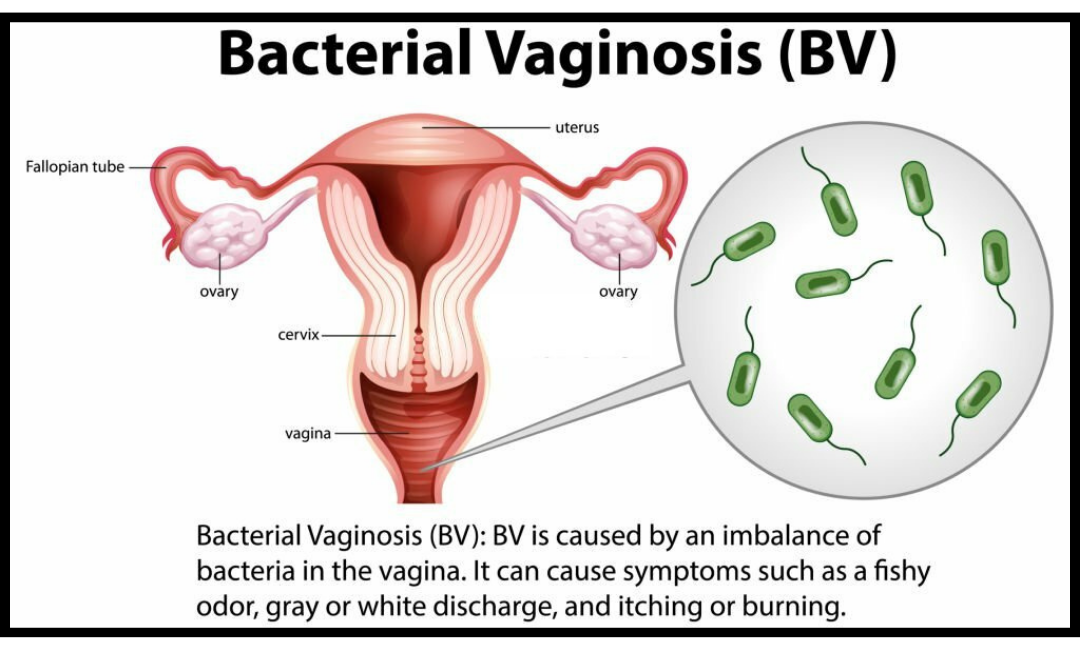 Stress Impact on Bacterial Vaginosis